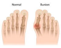 Early Symptoms of Bunions