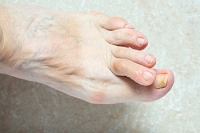 When Hammertoe Surgery May Not Be Effective