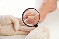 Risk Factors and Types of Toenail Fungus