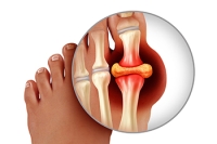 Managing Gout